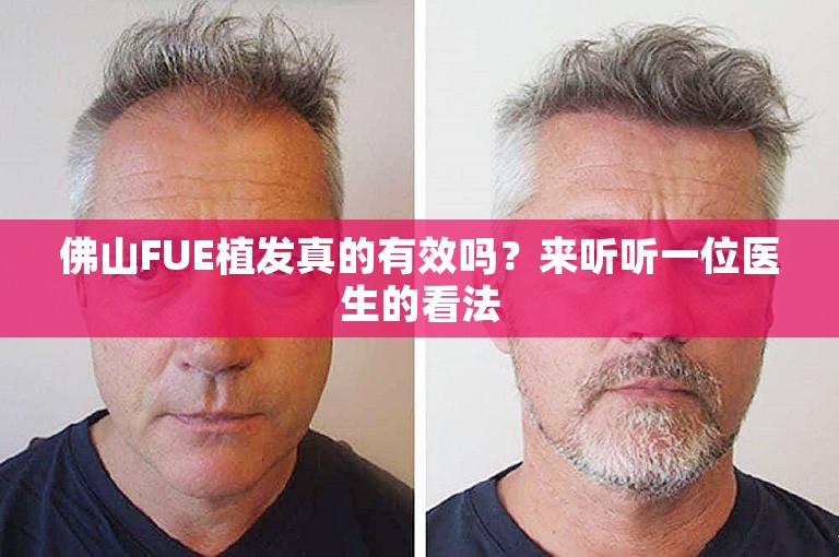 佛山FUE植发真的有效吗？来听听一位医生的看法