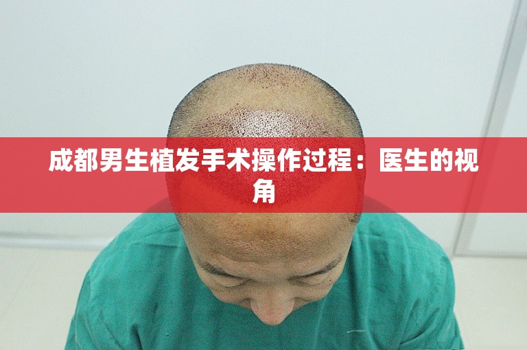 成都男生植发手术操作过程：医生的视角