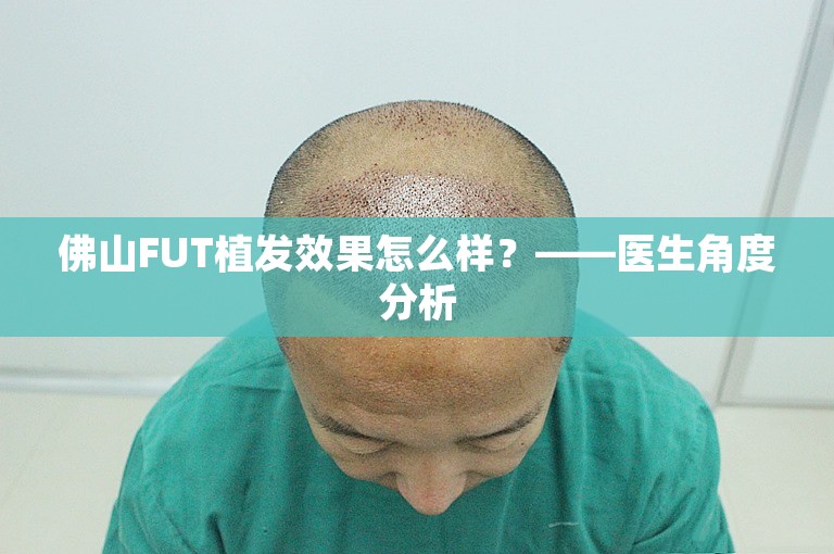 佛山FUT植发效果怎么样？——医生角度分析