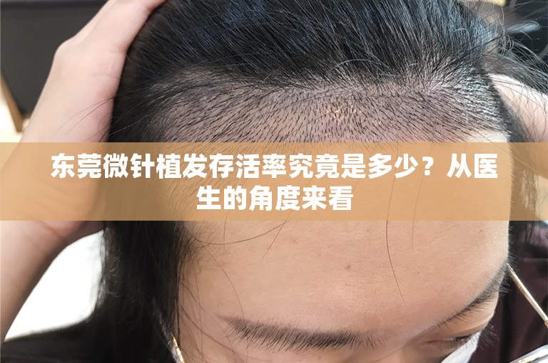 东莞微针植发存活率究竟是多少？从医生的角度来看