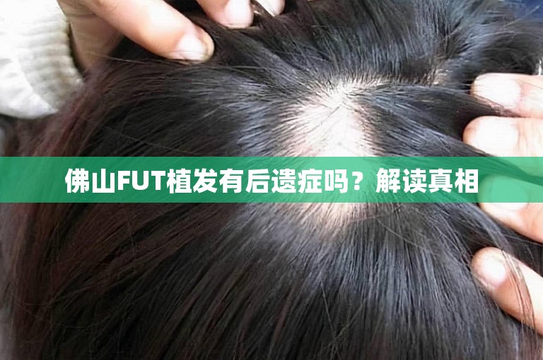 佛山FUT植发有后遗症吗？解读真相