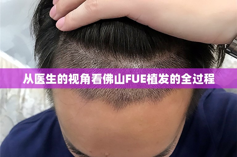 从医生的视角看佛山FUE植发的全过程