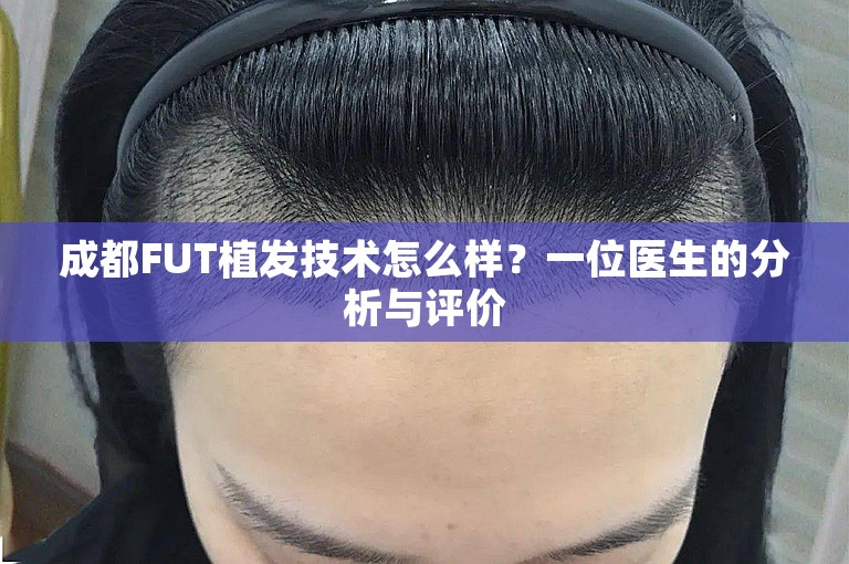 成都FUT植发技术怎么样？一位医生的分析与评价