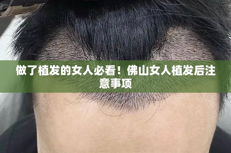 做了植发的女人必看！佛山女人植发后注意事项