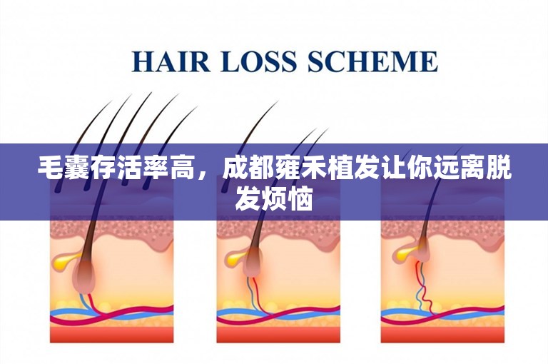 毛囊存活率高，成都雍禾植发让你远离脱发烦恼