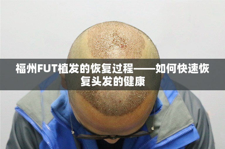 福州FUT植发的恢复过程——如何快速恢复头发的健康