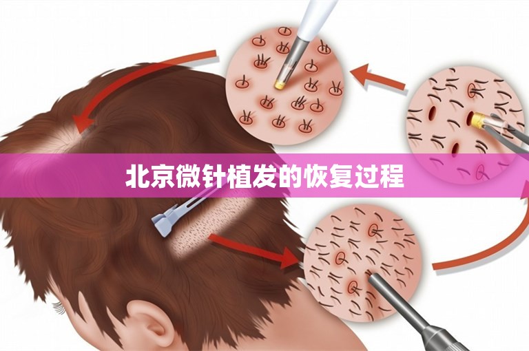 北京微针植发的恢复过程