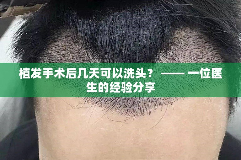 植发手术后几天可以洗头？ —— 一位医生的经验分享