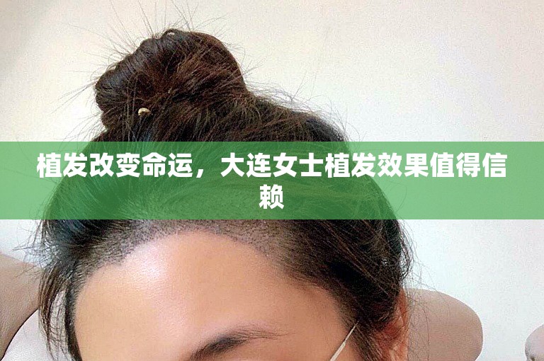 植发改变命运，大连女士植发效果值得信赖