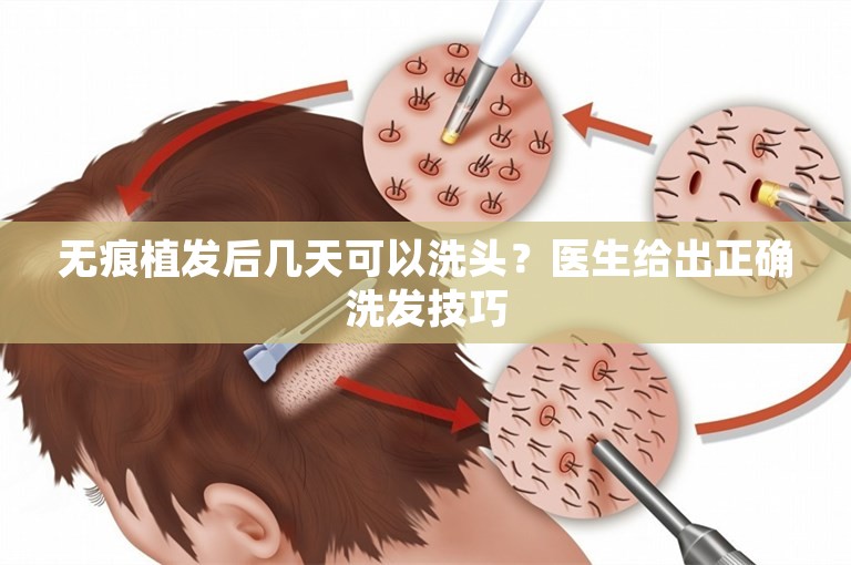 无痕植发后几天可以洗头？医生给出正确洗发技巧