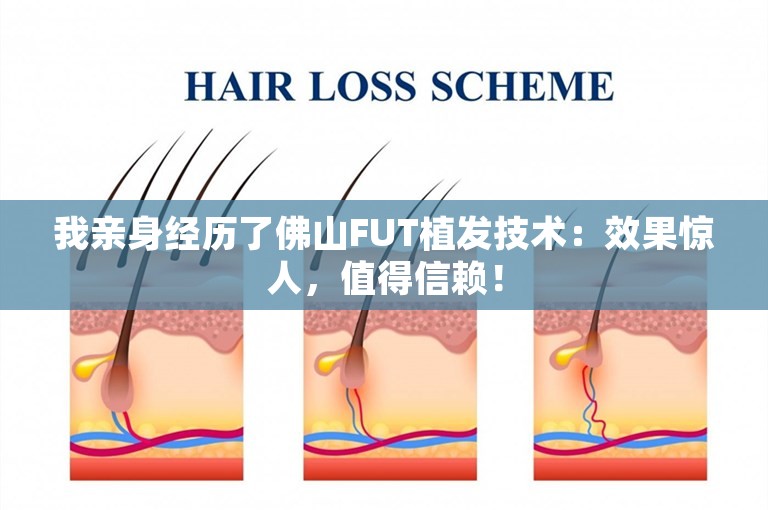 我亲身经历了佛山FUT植发技术：效果惊人，值得信赖！