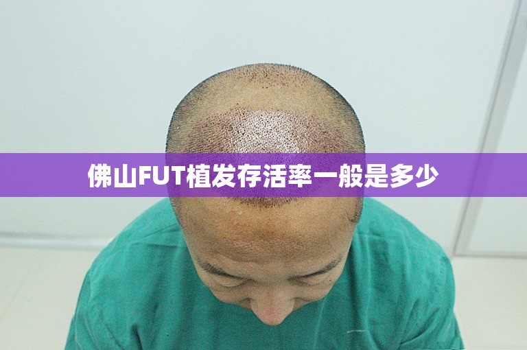 佛山FUT植发存活率一般是多少