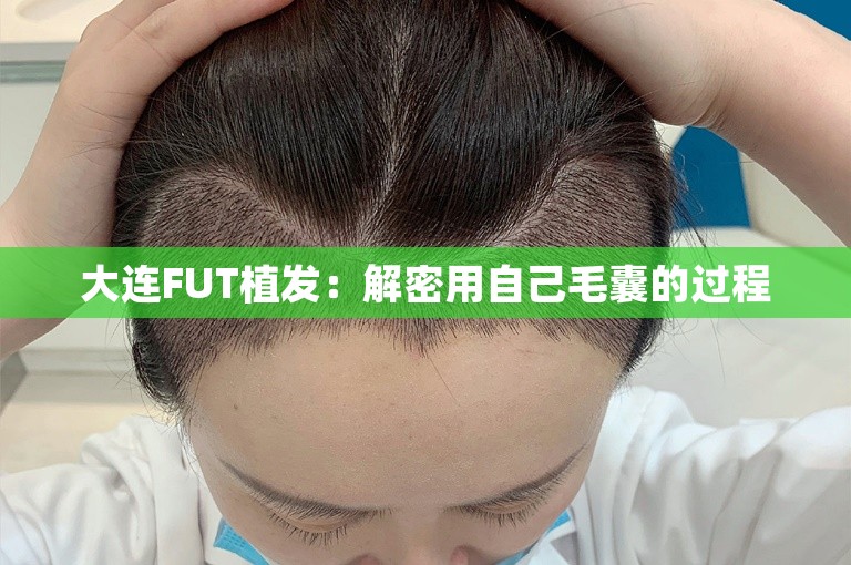 大连FUT植发：解密用自己毛囊的过程