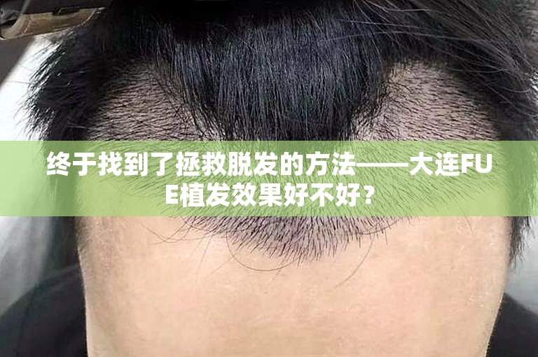 终于找到了拯救脱发的方法——大连FUE植发效果好不好？