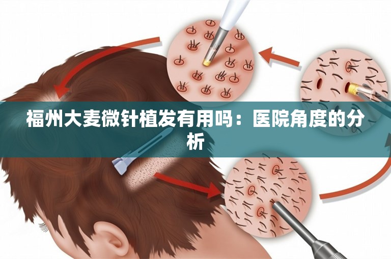 福州大麦微针植发有用吗：医院角度的分析