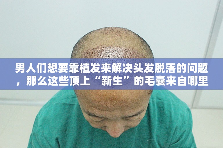 男人们想要靠植发来解决头发脱落的问题，那么这些顶上“新生”的毛囊来自哪里？