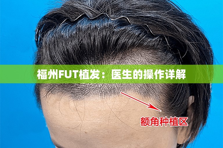 福州FUT植发：医生的操作详解