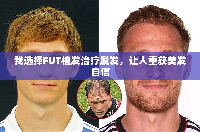 我选择FUT植发治疗脱发，让人重获美发自信