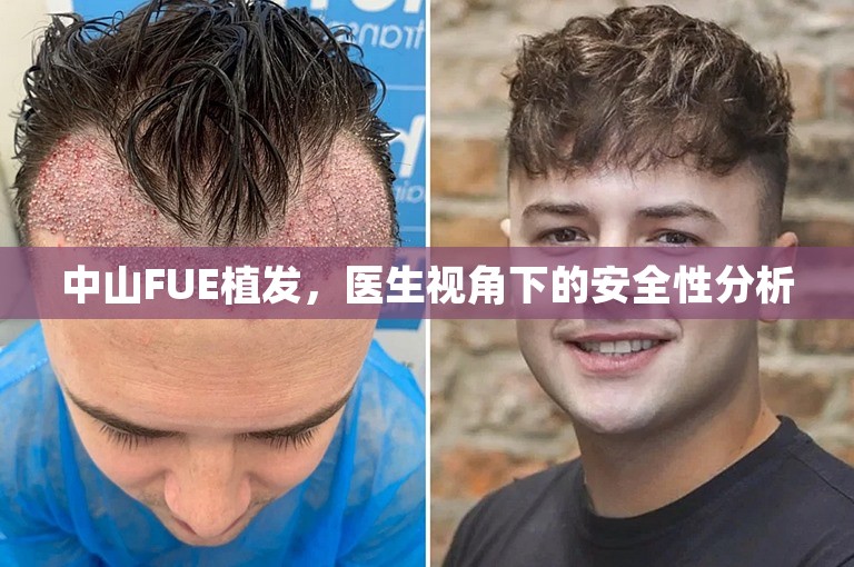 中山FUE植发，医生视角下的安全性分析