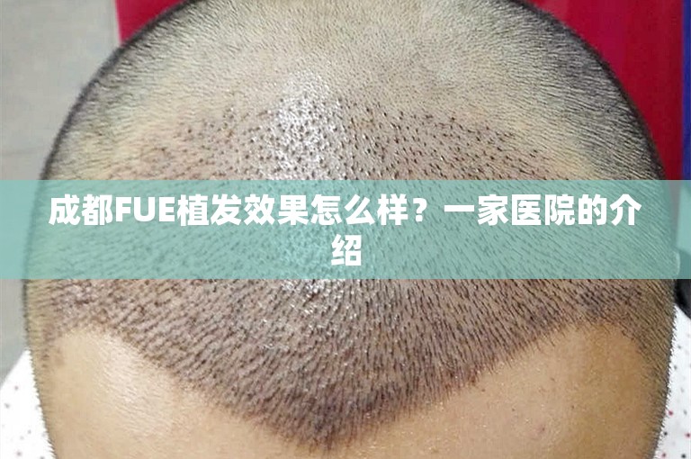 成都FUE植发效果怎么样？一家医院的介绍