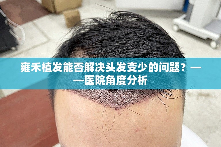 雍禾植发能否解决头发变少的问题？——医院角度分析