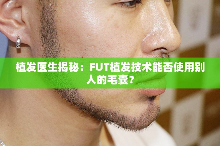 植发医生揭秘：FUT植发技术能否使用别人的毛囊？