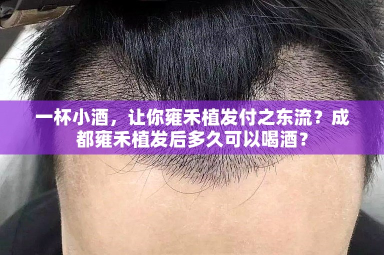 一杯小酒，让你雍禾植发付之东流？成都雍禾植发后多久可以喝酒？