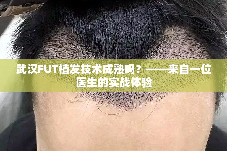 武汉FUT植发技术成熟吗？——来自一位医生的实战体验