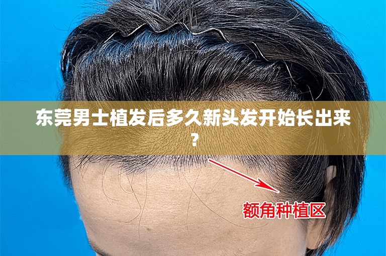 东莞男士植发后多久新头发开始长出来？