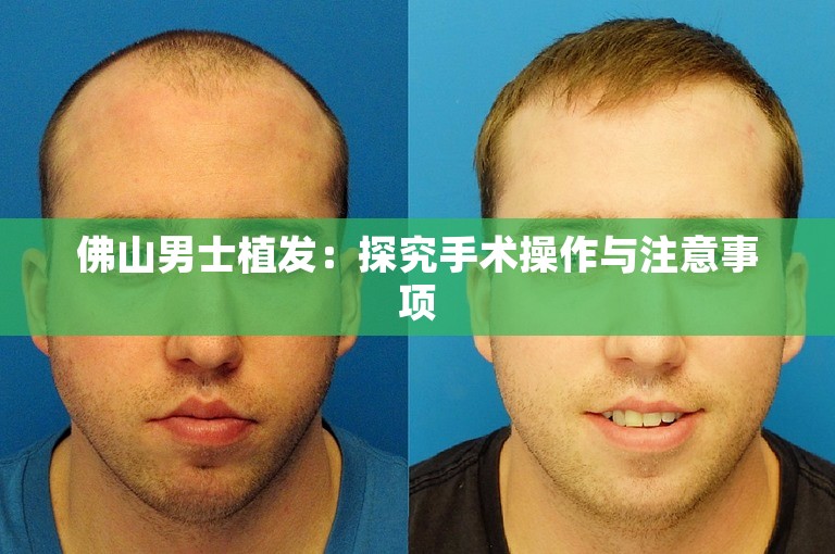 佛山男士植发：探究手术操作与注意事项