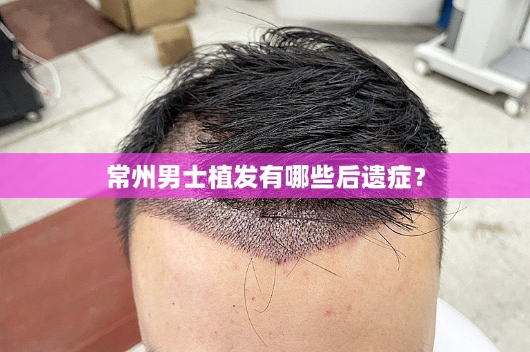 常州男士植发有哪些后遗症？