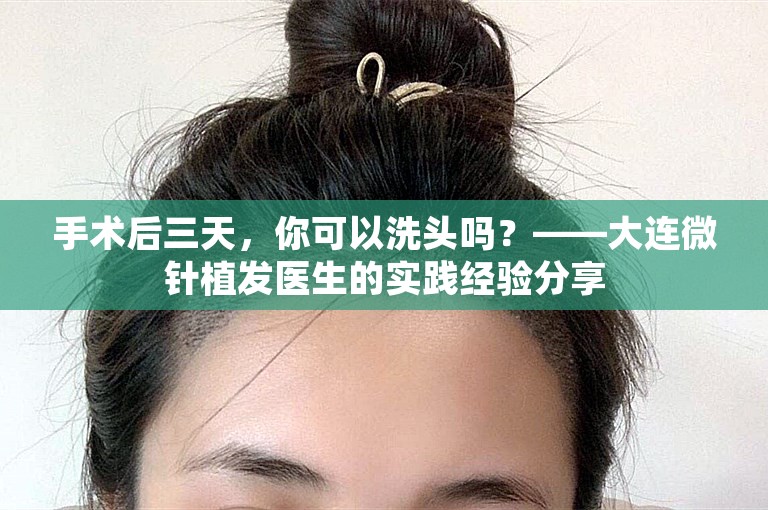 手术后三天，你可以洗头吗？——大连微针植发医生的实践经验分享