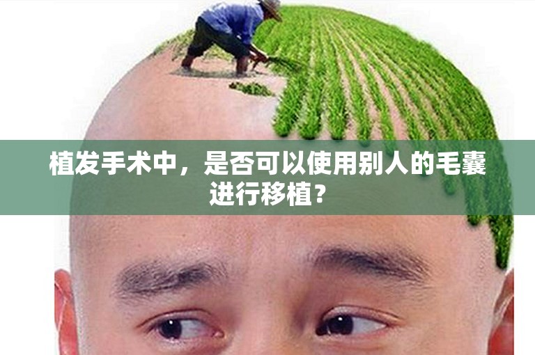 植发手术中，是否可以使用别人的毛囊进行移植？