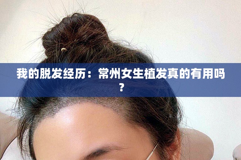 我的脱发经历：常州女生植发真的有用吗？