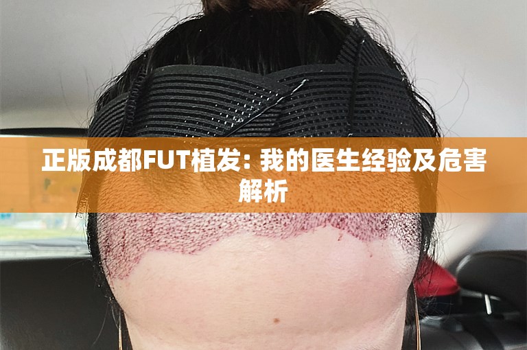 正版成都FUT植发: 我的医生经验及危害解析