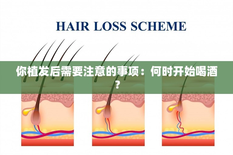 你植发后需要注意的事项：何时开始喝酒？