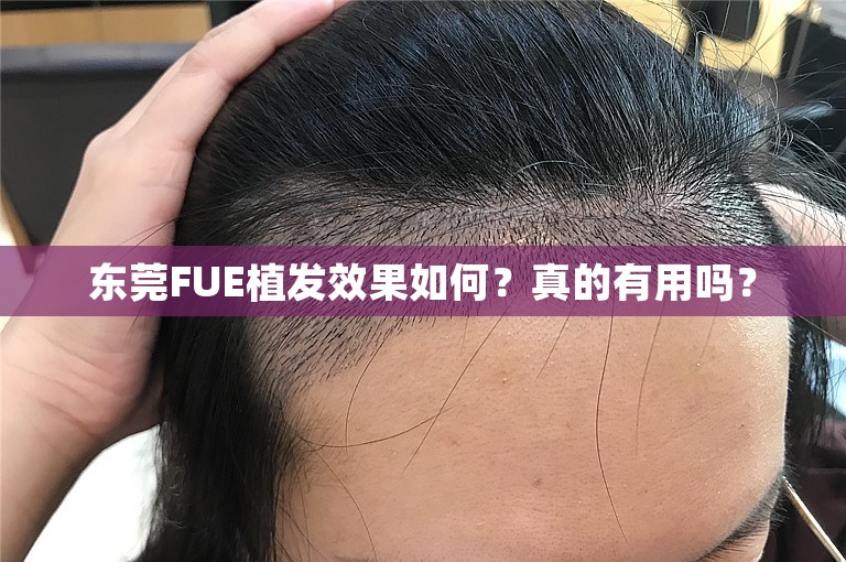 东莞FUE植发效果如何？真的有用吗？