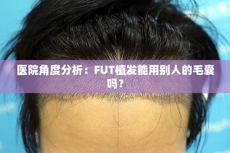 医院角度分析：FUT植发能用别人的毛囊吗？