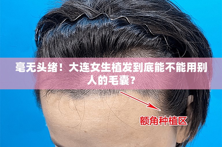 毫无头绪！大连女生植发到底能不能用别人的毛囊？