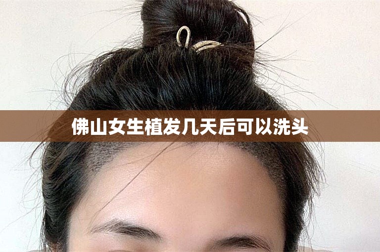 佛山女生植发几天后可以洗头