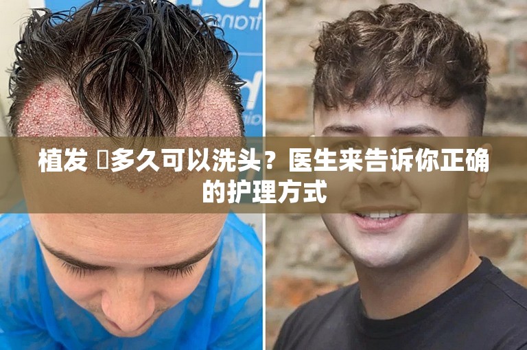 植发 후多久可以洗头？医生来告诉你正确的护理方式