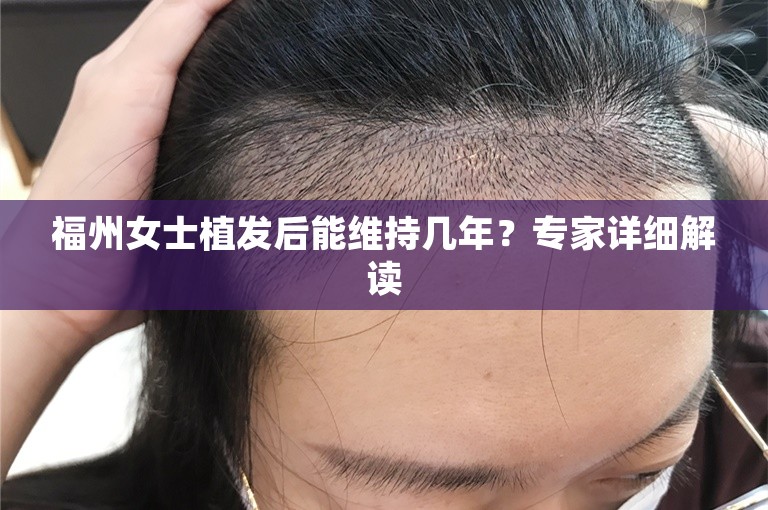 福州女士植发后能维持几年？专家详细解读