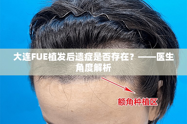 大连FUE植发后遗症是否存在？——医生角度解析