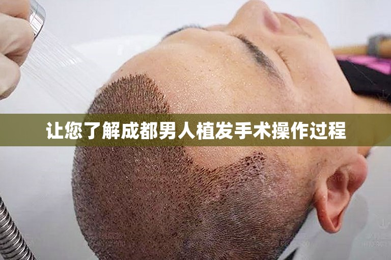 让您了解成都男人植发手术操作过程