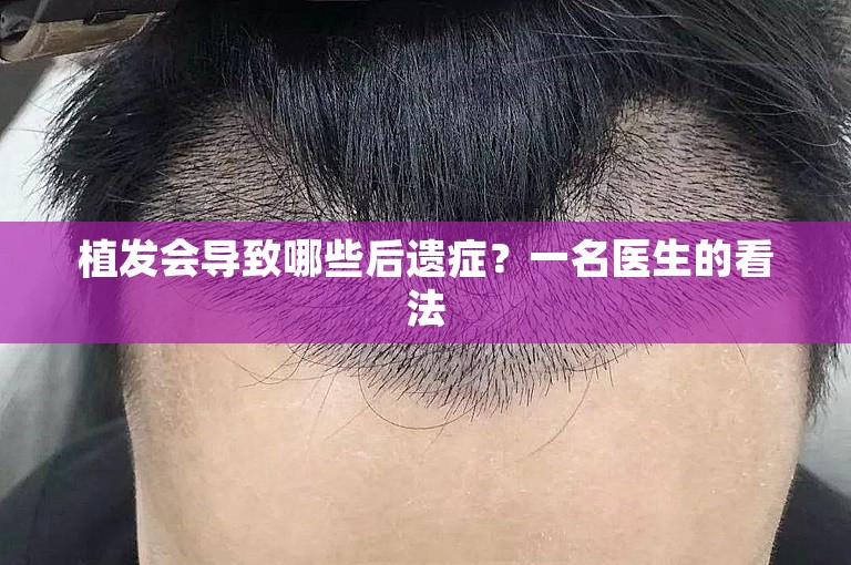 植发会导致哪些后遗症？一名医生的看法