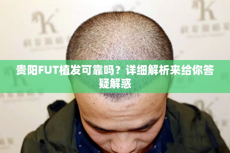 贵阳FUT植发可靠吗？详细解析来给你答疑解惑