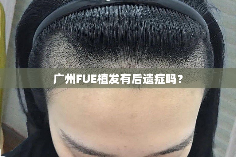 广州FUE植发有后遗症吗？