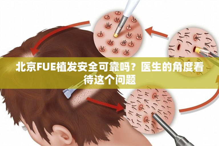 北京FUE植发安全可靠吗？医生的角度看待这个问题