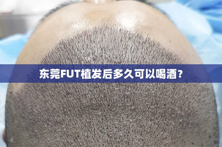 东莞FUT植发后多久可以喝酒？