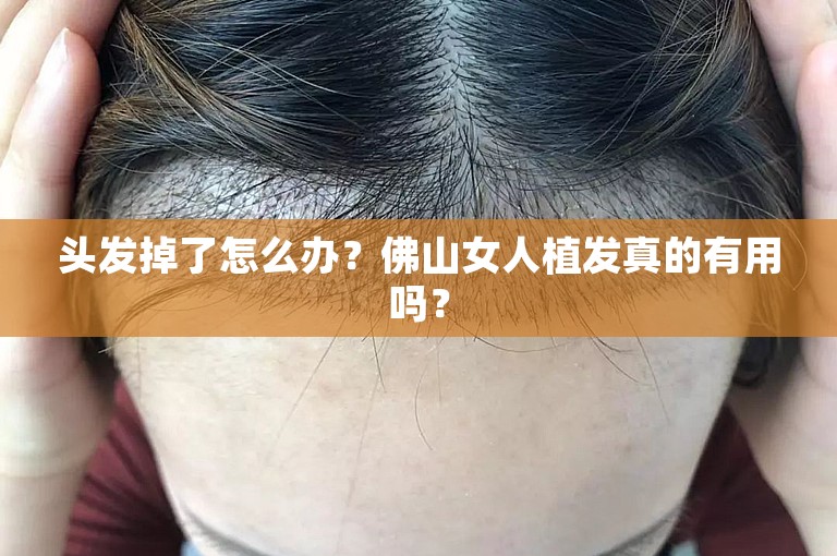 头发掉了怎么办？佛山女人植发真的有用吗？